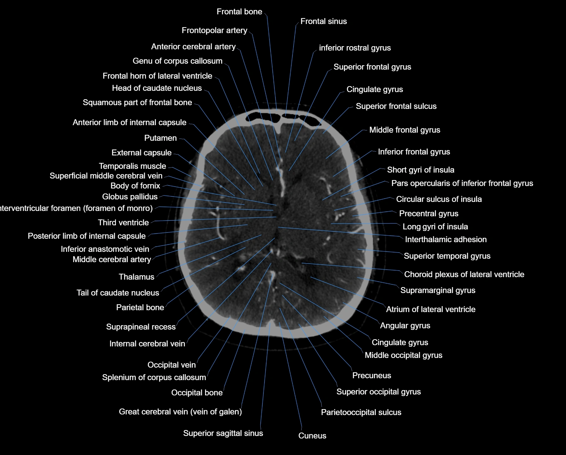 CT scan brain axial labelled cross sectional anatomy image-img-000036.webp